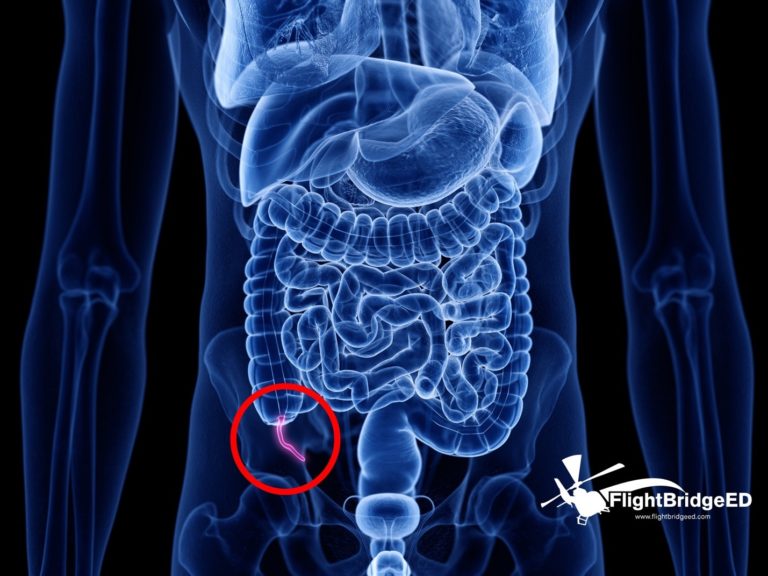 Appendicitis