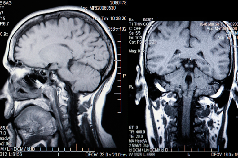 Brain Aneurysm