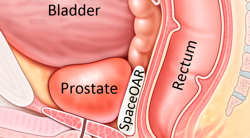 Prostate cancer